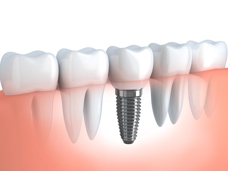Dental Implants Reisterstown, MD 